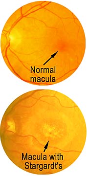 Stargardt's disease